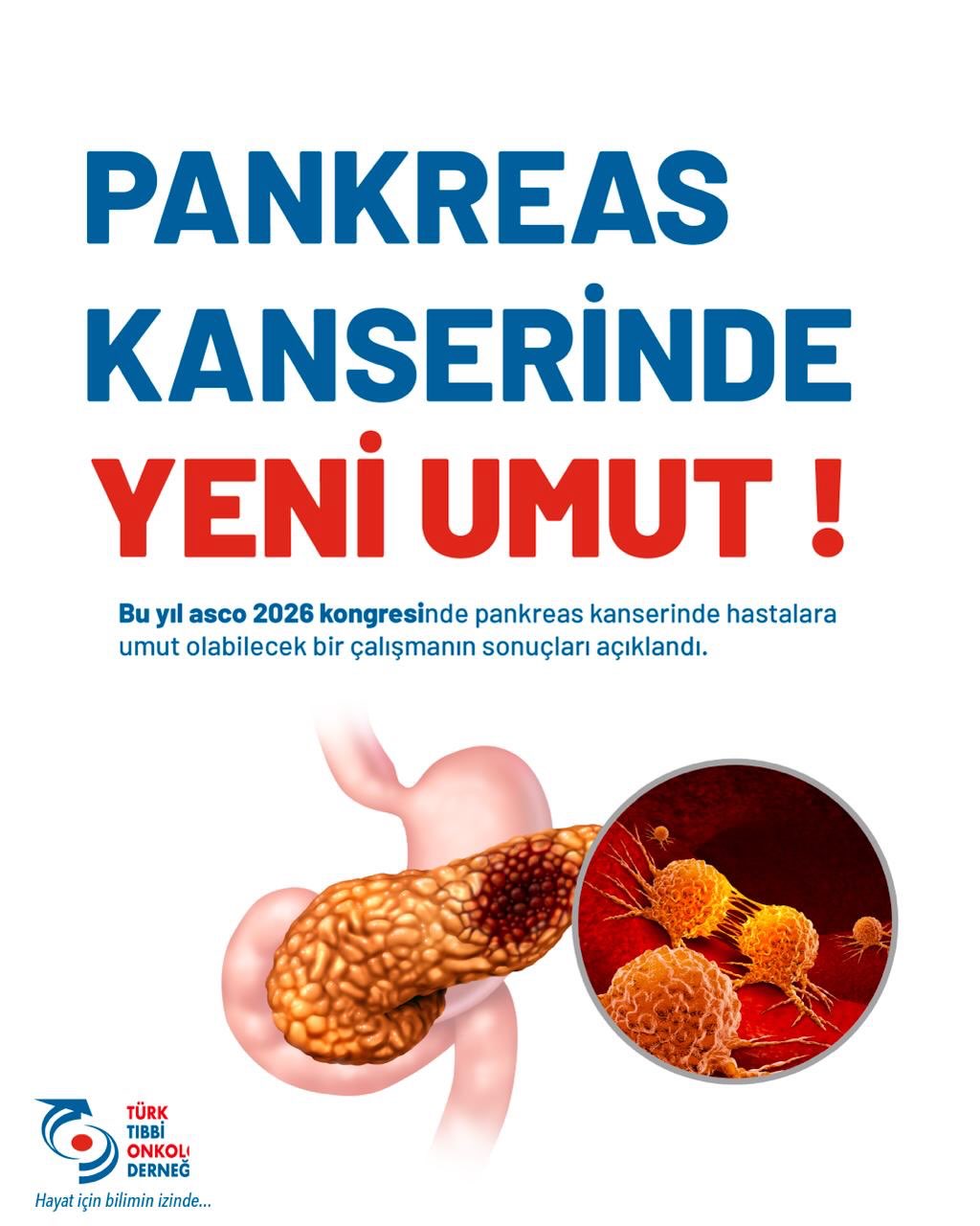 PANKREAS KANSERİNDE UMUT VEREN GELİŞME